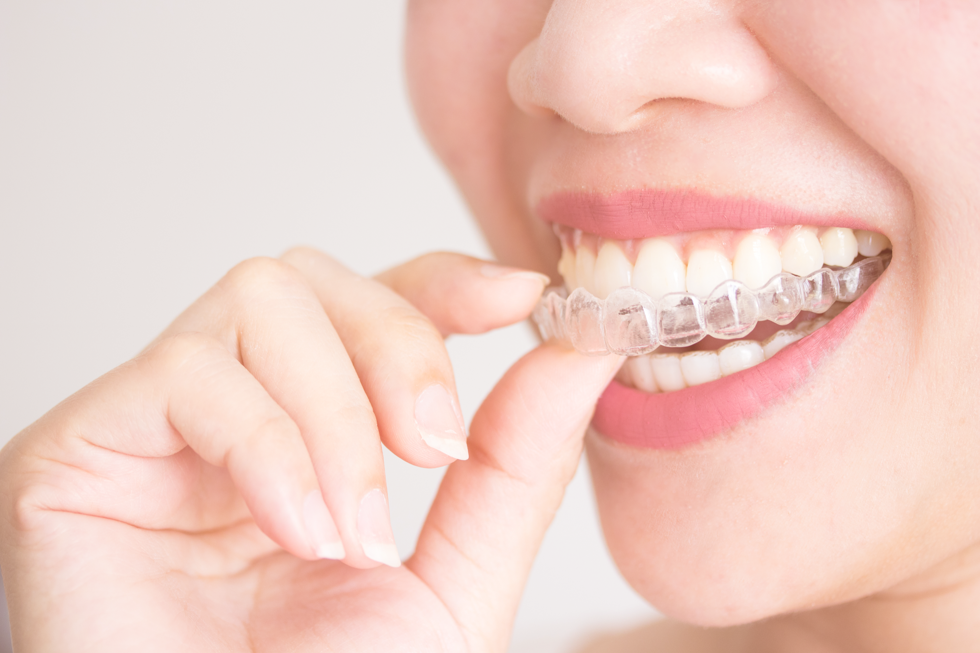 Invisalign clear aligner