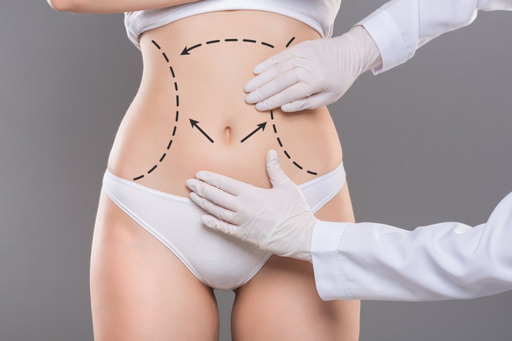 Liposuction Fat Transfer