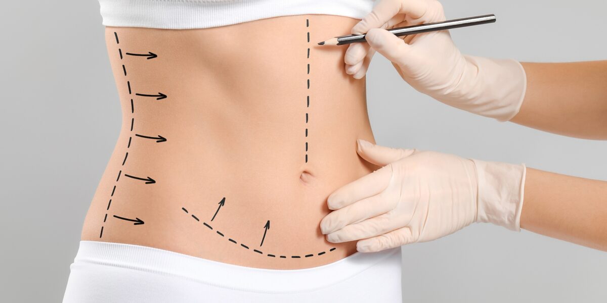 Tummy Tuck in Dubai