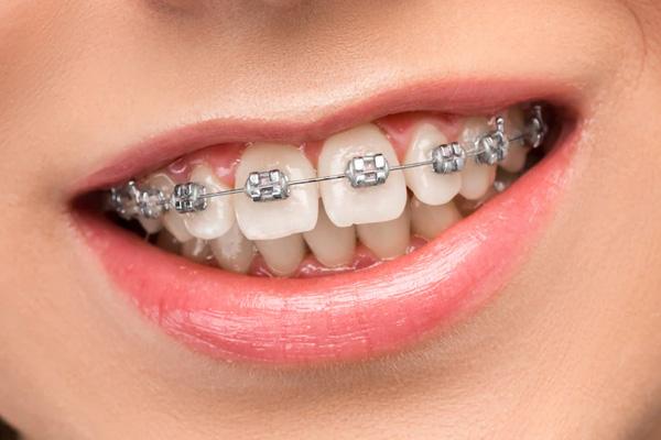 metal braces
