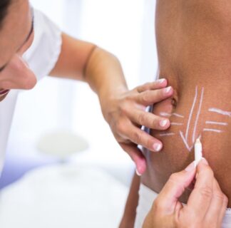 surgeon drawing lines womans abdomen liposuction cellulite removal 1