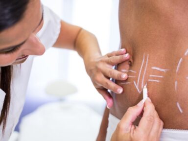 surgeon drawing lines womans abdomen liposuction cellulite removal 1